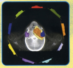 Image-guided radiotherapy (IGRT).png