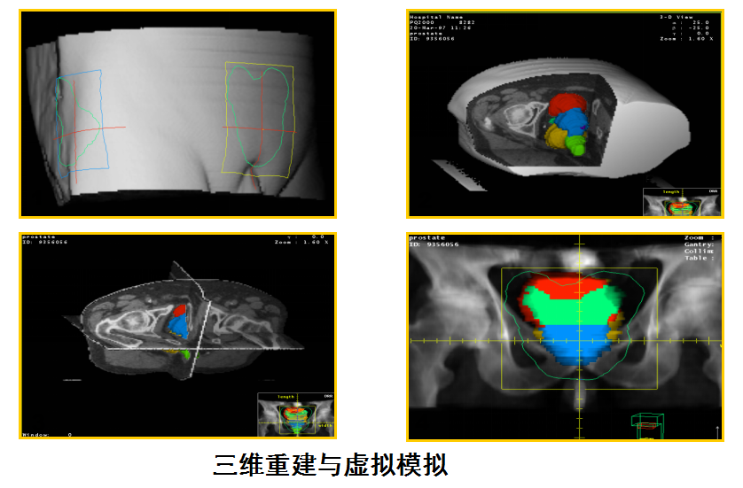 放疗流程3.png