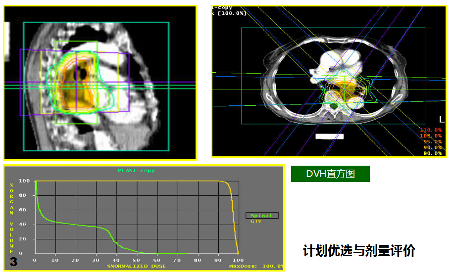 放疗流程4.png